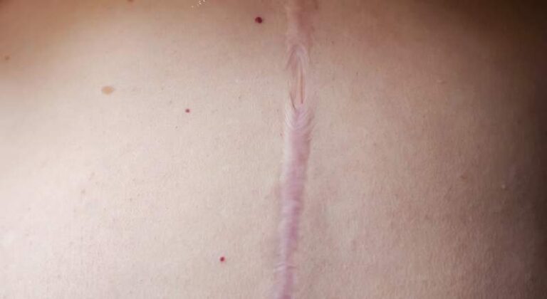 Masaż blizn pooperacyjnych